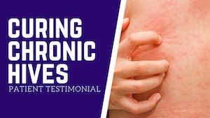 Chronic-Urticaria-Hives